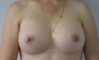 Breast Augmentation Revision Before & After Patient #7666