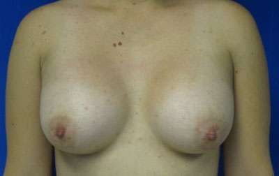Breast Augmentation Revision Before & After Patient #7672
