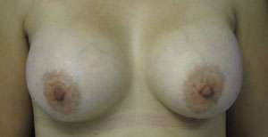 Breast Augmentation Revision Before & After Patient #7678