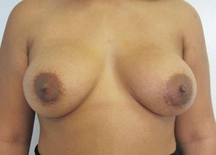 Breast Augmentation Revision Before & After Patient #7681
