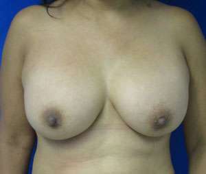 Breast Augmentation Revision Before & After Patient #7684