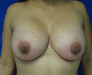 Breast Augmentation Revision Before & After Patient #7687