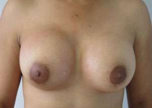 Breast Augmentation Revision Before & After Patient #7693