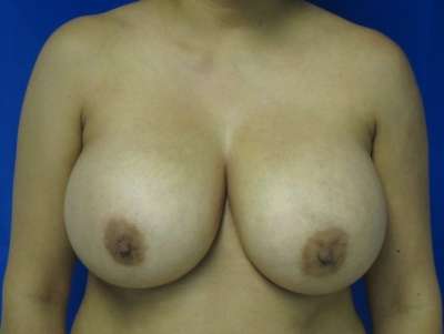 Breast Augmentation Revision Before & After Patient #7699