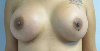 Breast Augmentation Revision Before & After Patient #7708