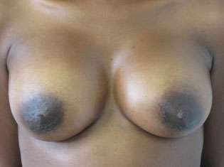 Breast Augmentation Revision Before & After Patient #7723