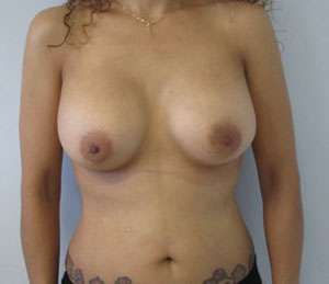 Breast Augmentation Revision Before & After Patient #7732