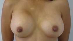 Breast Augmentation Revision Before & After Patient #7735