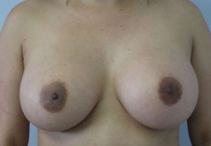 Breast Augmentation Revision Before & After Patient #7738