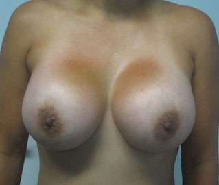 Breast Augmentation Revision Before & After Patient #7744