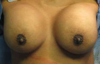 Breast Augmentation Revision Before & After Patient #7747