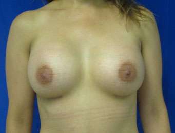 Breast Augmentation Revision Before & After Patient #7753