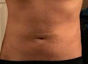 Bodytite Before & After Patient #6060
