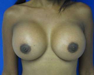Breast Augmentation Revision Before & After Patient #7759