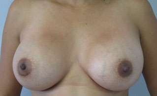 Breast Augmentation Revision Before & After Patient #7765