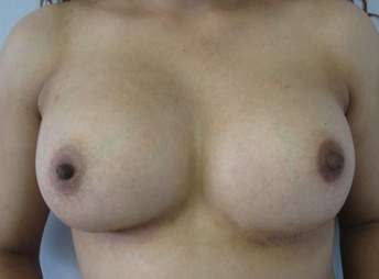 Breast Augmentation Revision Before & After Patient #7789