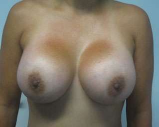 Breast Augmentation Revision Before & After Patient #7795