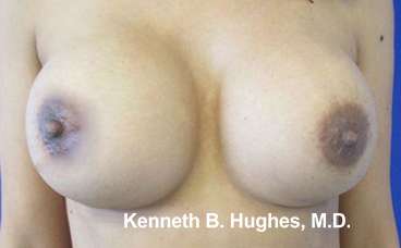Breast Augmentation with Fat Grafting Before & After Patient #7798