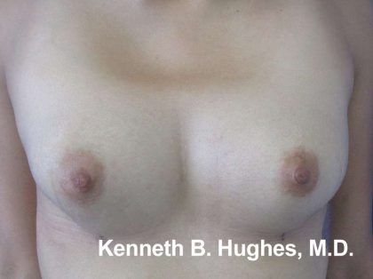 Breast Augmentation with Fat Grafting Before & After Patient #7801