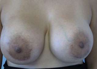 Breast Augmentation with Fat Grafting Before & After Patient #7804