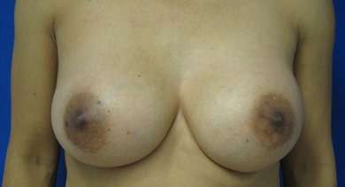 Breast Augmentation with Fat Grafting Before & After Patient #7810
