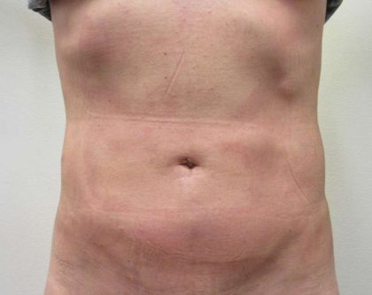 Bodytite Before & After Patient #6066