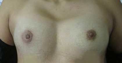 Breast Augmentation with Fat Grafting Before & After Patient #7819