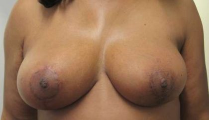 Breast Lift Before & After Patient #7828