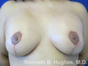 Breast Lift Before & After Patient #7842