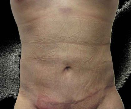Bodytite Before & After Patient #6069