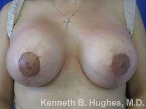 Breast Lift Before & After Patient #7854