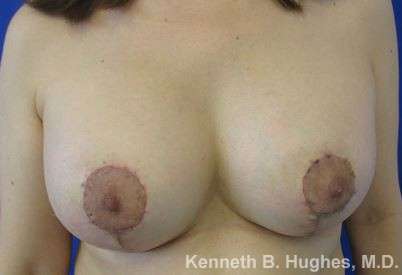 Breast Lift Before & After Patient #7857
