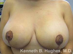 Breast Lift Before & After Patient #7860