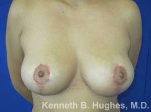 Breast Lift Before & After Patient #7863