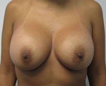 Breast Lift Before & After Patient #7866