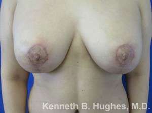 Breast Lift Before & After Patient #7872