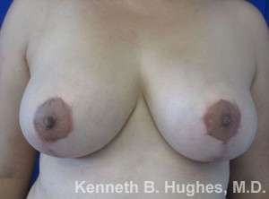 Breast Lift Before & After Patient #7875