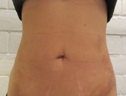 Bodytite Before & After Patient #6072