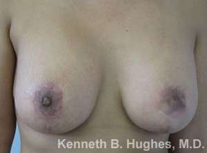 Breast Lift Before & After Patient #7884