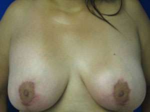 Breast Lift Before & After Patient #7893