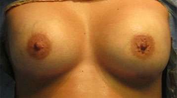 Breast Lift Before & After Patient #7899