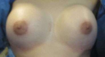 Breast Lift Before & After Patient #7902