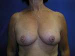 Breast Lift Before & After Patient #7908