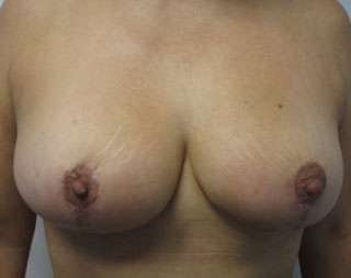 Breast Lift Before & After Patient #7917