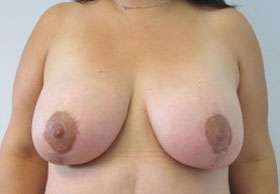 Breast Lift Before & After Patient #7930
