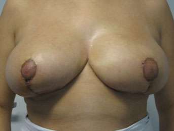 Breast Lift Before & After Patient #7939