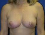 Breast Lift Before & After Patient #7942