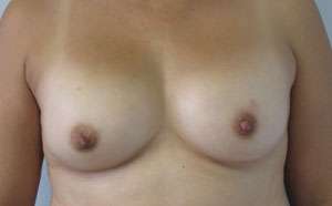 Breast Reconstruction and Breast Deformity Correction Before & After Patient #7948
