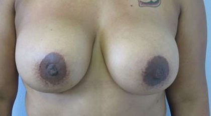Breast Reconstruction and Breast Deformity Correction Before & After Patient #7966