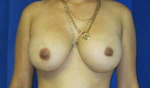 Breast Reconstruction and Breast Deformity Correction Before & After Patient #7975